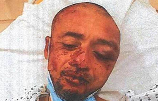A photo released by the San Francisco Public Defender's office shows Sergio Lugo with severe facial injuries after an altercation with police last February. Photo: Courtesy SF Public Defender's office